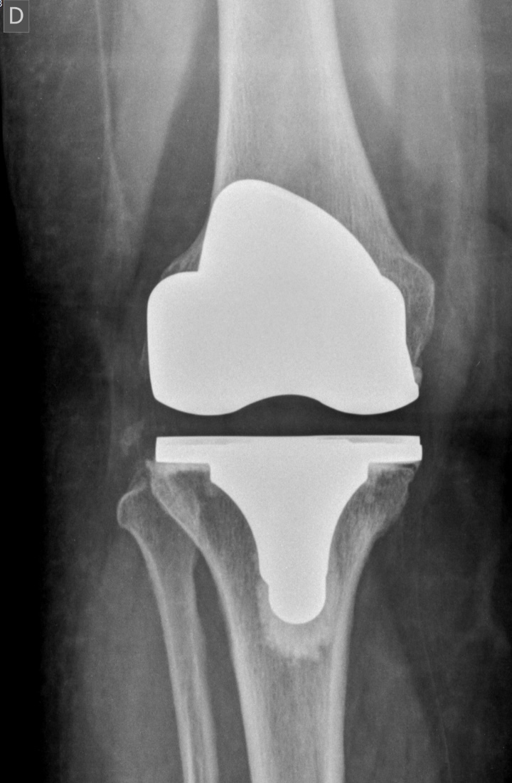 Radiografia de joelho com prótese total, incidência de frente