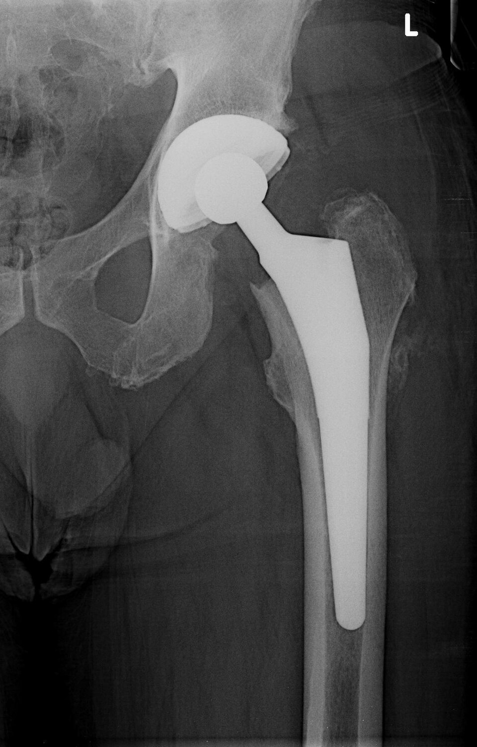 Radiografia de quadril com prótese total (artroplastia), incidência anteroposterior